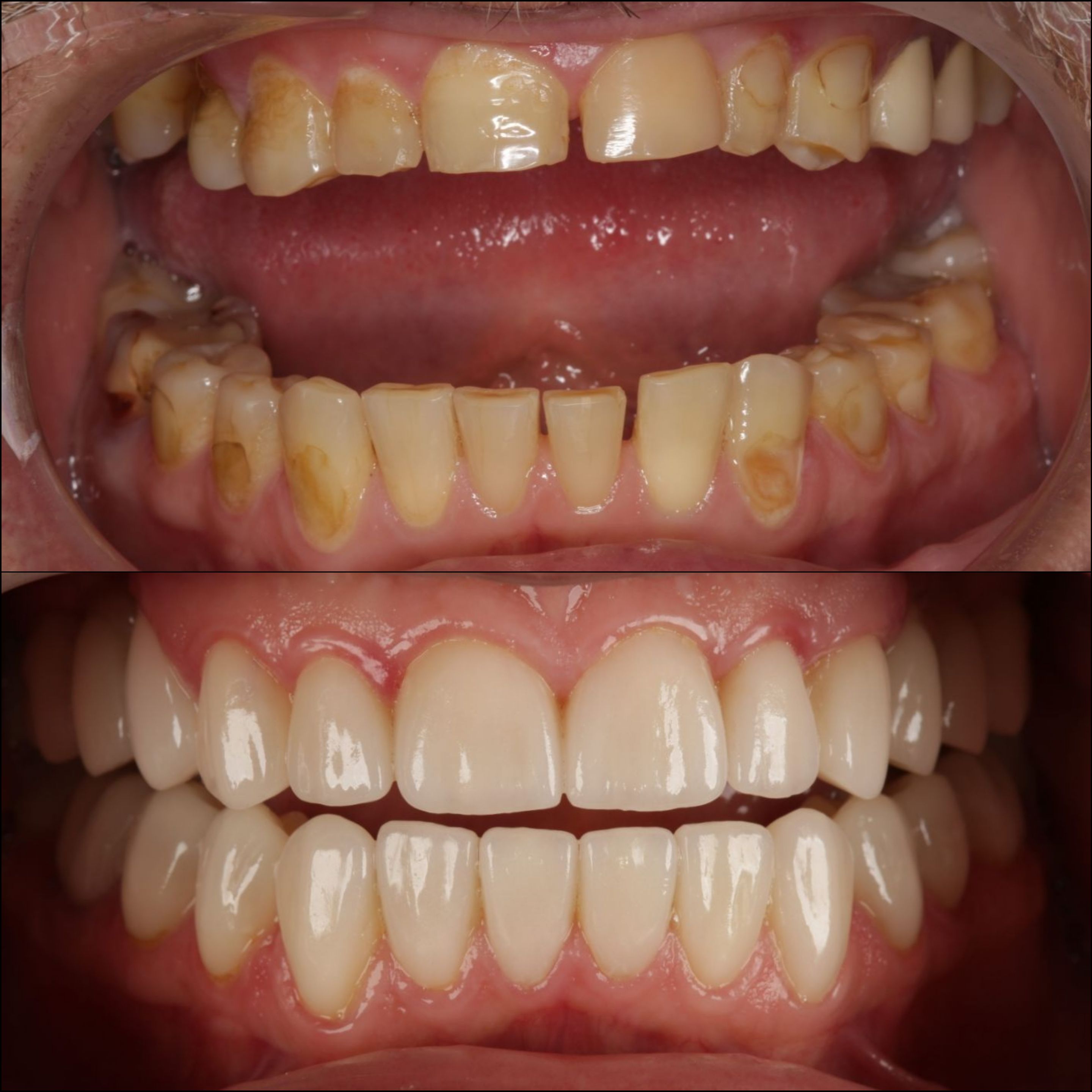 Тотальная реабилитация керамическими винирами зубов верхней и нижней челюсти